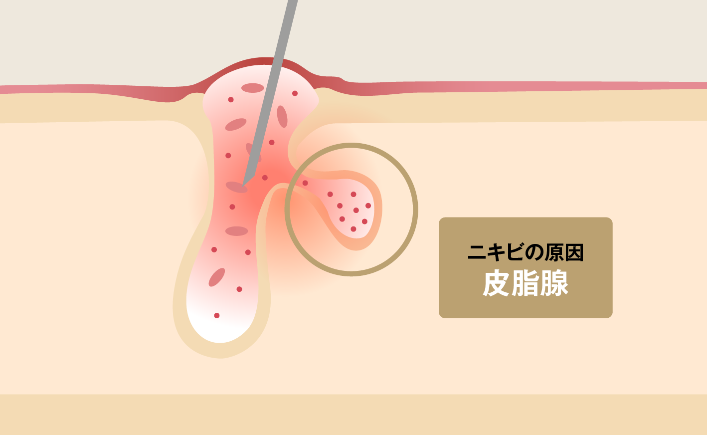 ニキビの原因皮脂腺
