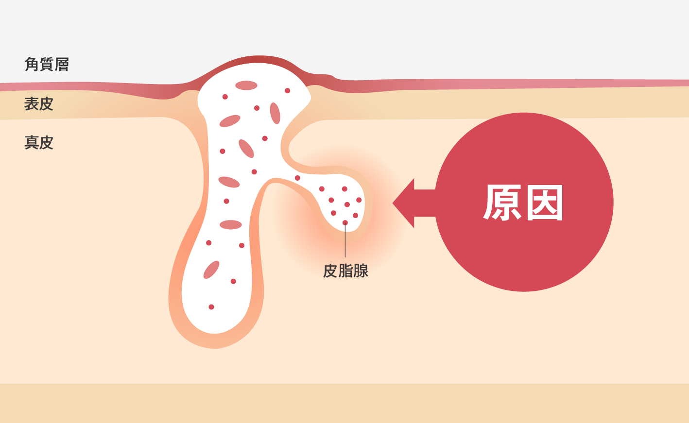 ニキビの原因