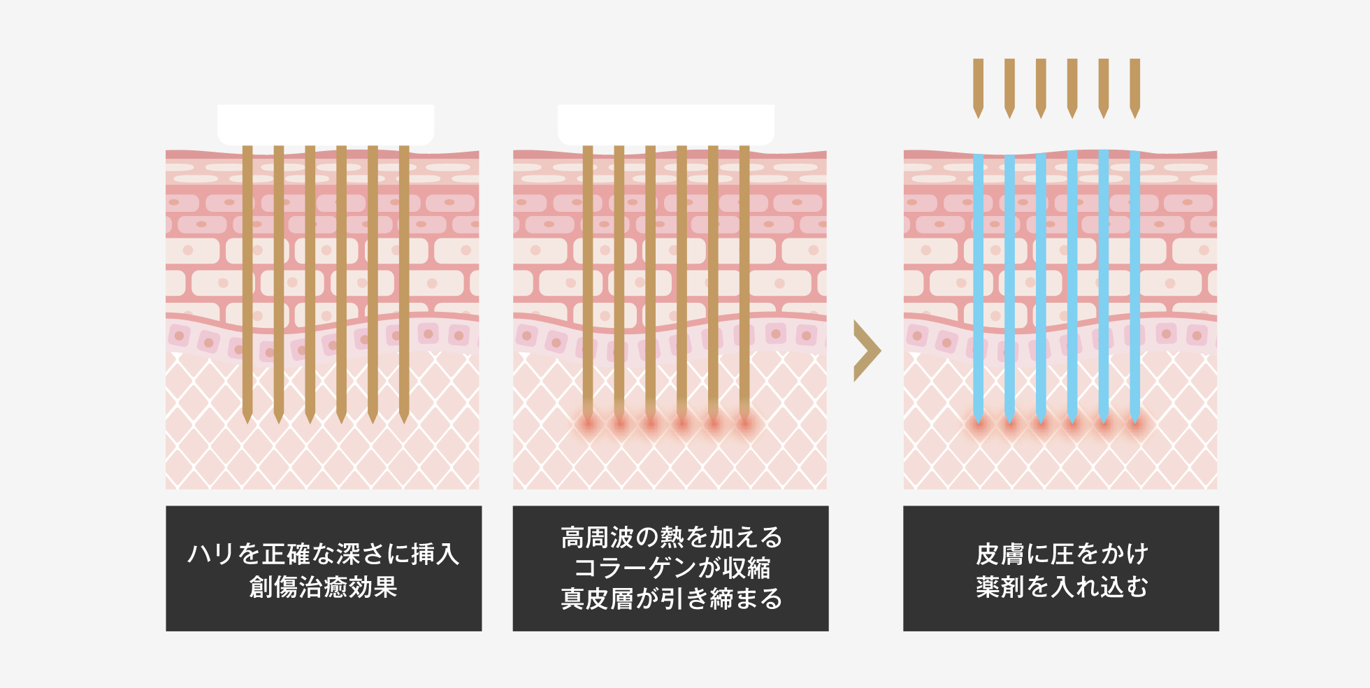 ニキビ跡の凹み治療（ポテンツァ）