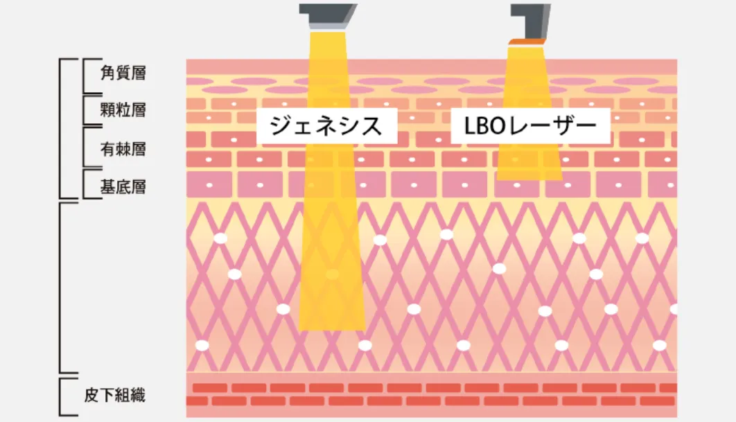 赤み・色素沈着治療の仕組み