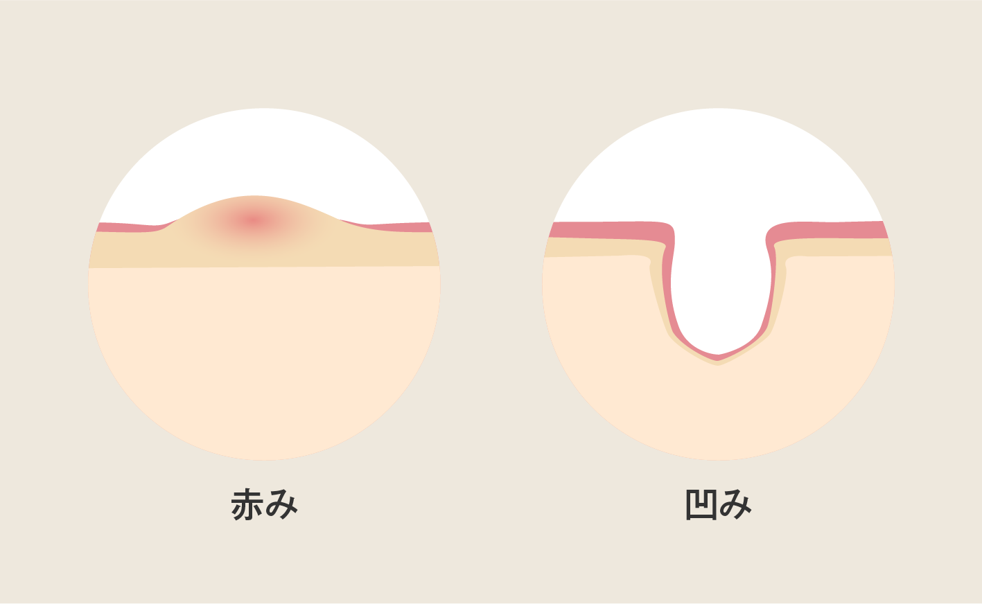 男性のニキビ跡に特化したプラン
