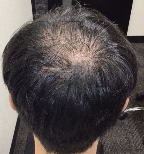 施術前