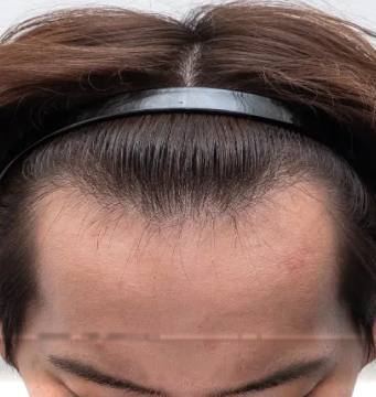 症例2 BEFORE