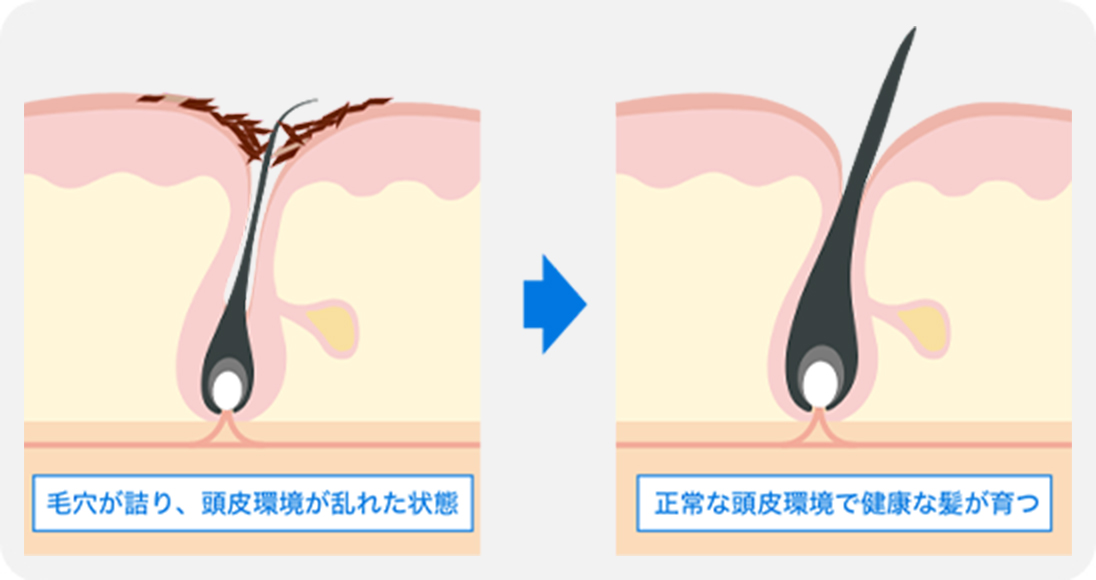 健康な髪は頭皮から