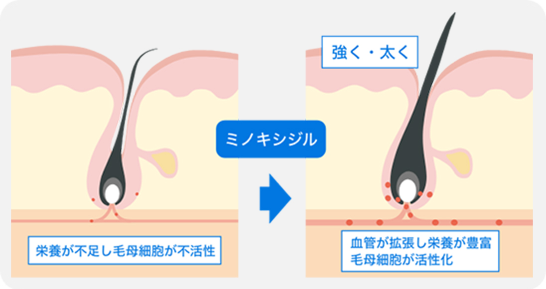 頭髪が育たない仕組み