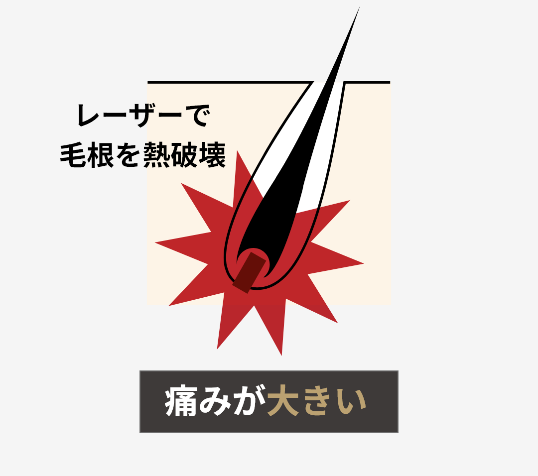 レーザーで毛根を熱破壊　痛みが大きい
