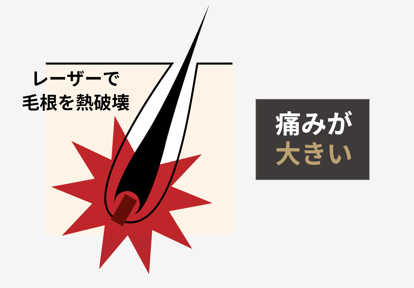 レーザーで毛根を熱破壊　痛みが大きい