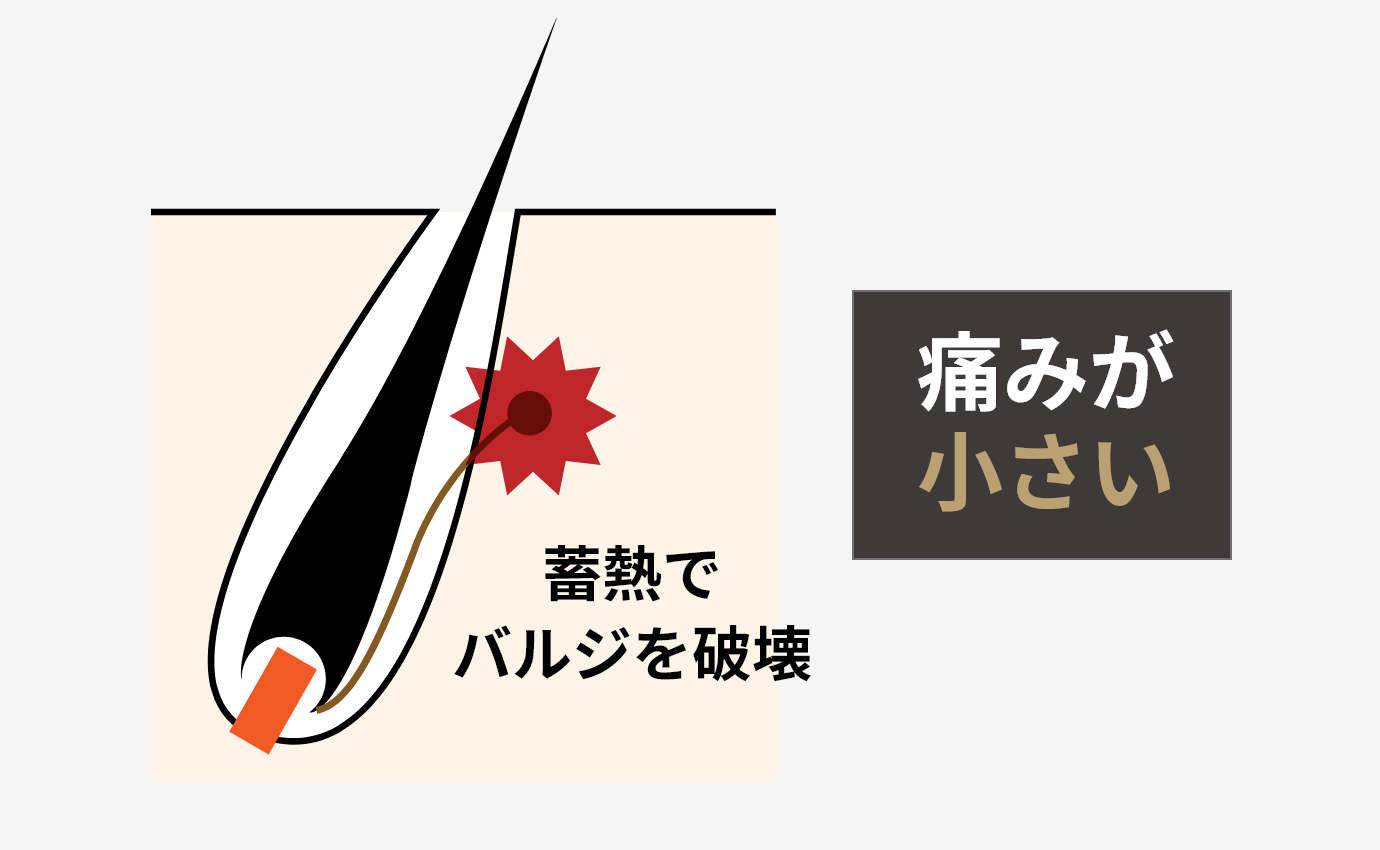 蓄熱でバルジを破壊　痛みが小さい