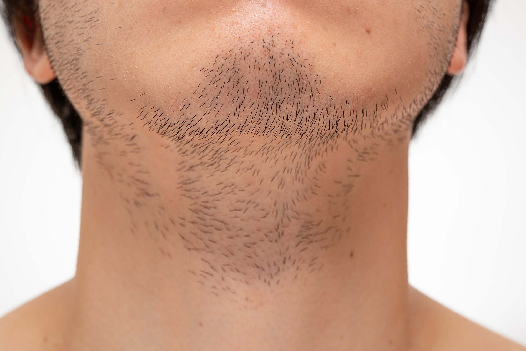 Before,Beard,Hair,Removal.,This,Beard,Has,Not,Been,Shaved