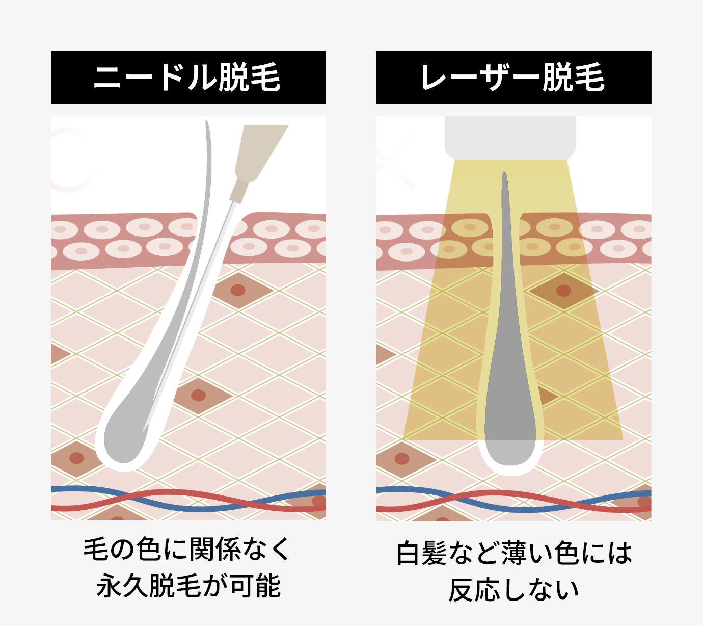 ニードル脱毛とレーザー脱毛との違い