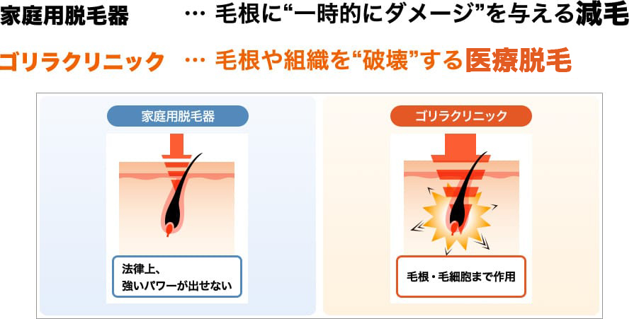 家庭用脱毛器…毛根に”一時的にダメージ”を与える減毛 ゴリラクリニック…毛根や組織を”破壊”する医療脱毛”