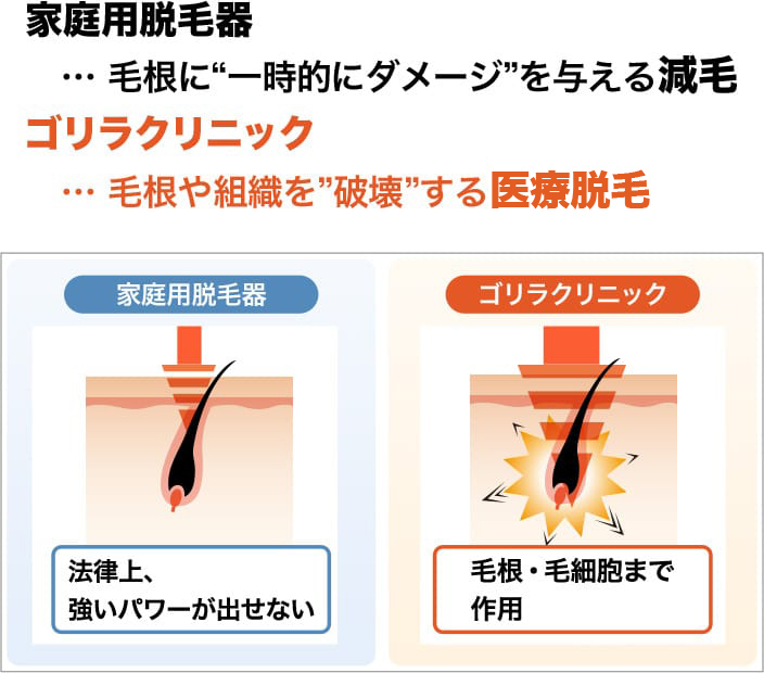 家庭用脱毛器…毛根に”一時的にダメージ”を与える減毛 ゴリラクリニック…毛根や組織を”破壊”する医療脱毛”