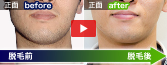 今中 一成さんの脱毛ビフォーアフター