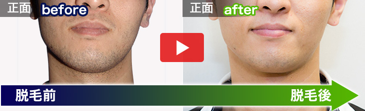 今中 一成さんの脱毛ビフォーアフター