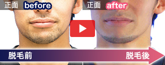 皆本 晃さんの脱毛ビフォーアフター