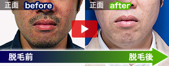 鈴木 直哉さんの脱毛ビフォーアフター