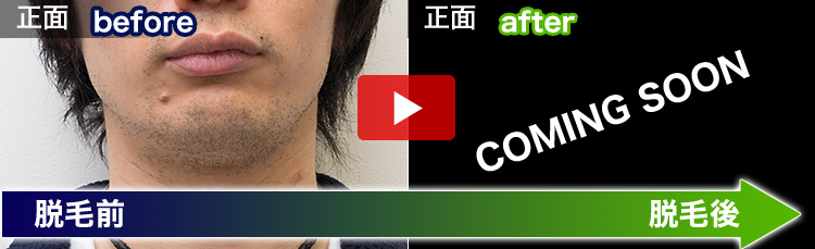 島 陽平さんの脱毛ビフォーアフター