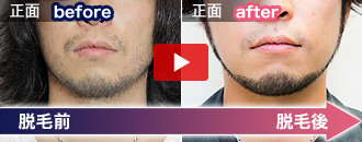 山下 憂也さんの脱毛ビフォーアフター