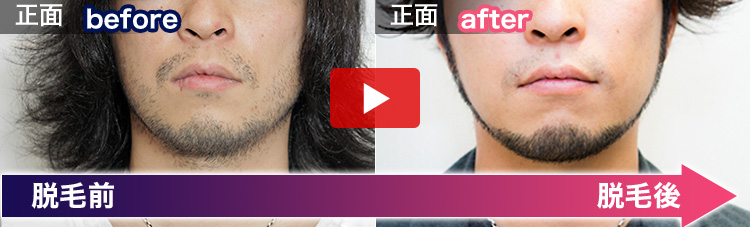 山下 憂也さんの脱毛ビフォーアフター