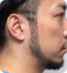シミそばかす治療：スポットレーザー After