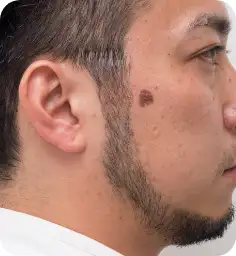シミそばかす治療：スポットレーザー Before