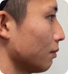シミそばかす治療：スポットレーザー Before