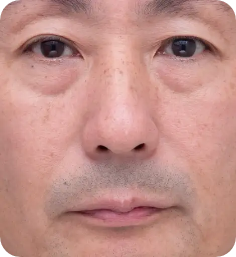 シミそばかす治療：ゴリラシミ治療（ステラM22） Before
