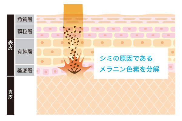 スペクトラ（QスイッチYAGレーザー）の効果・仕組み