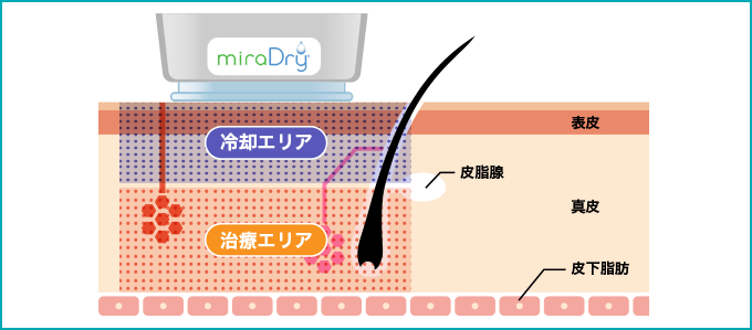 ミラドライの治療内容