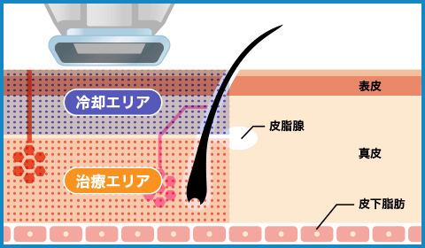 広範囲の汗腺に作用するので効果が高い