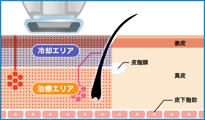 広範囲の汗腺に作用するので効果が高い
