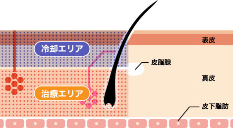 ミラドライなら両方の汗腺の働きを一度の照射で抑制します。