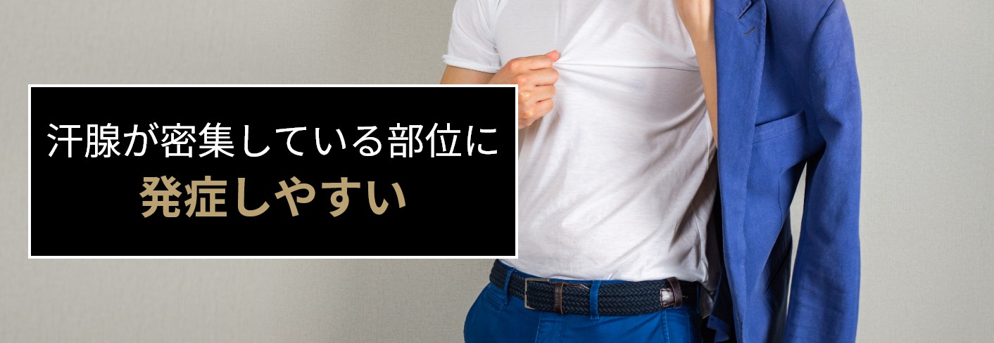 多汗症は汗腺が密集している部位に発症しやすい