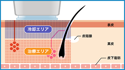 ミラドライの構造