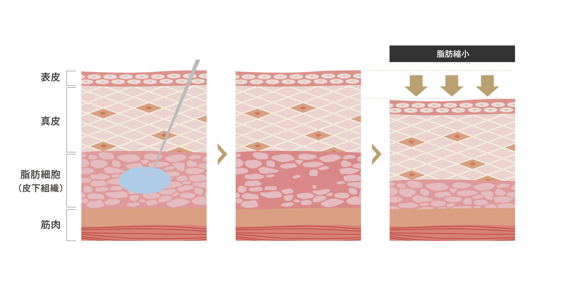 脂肪溶解注射