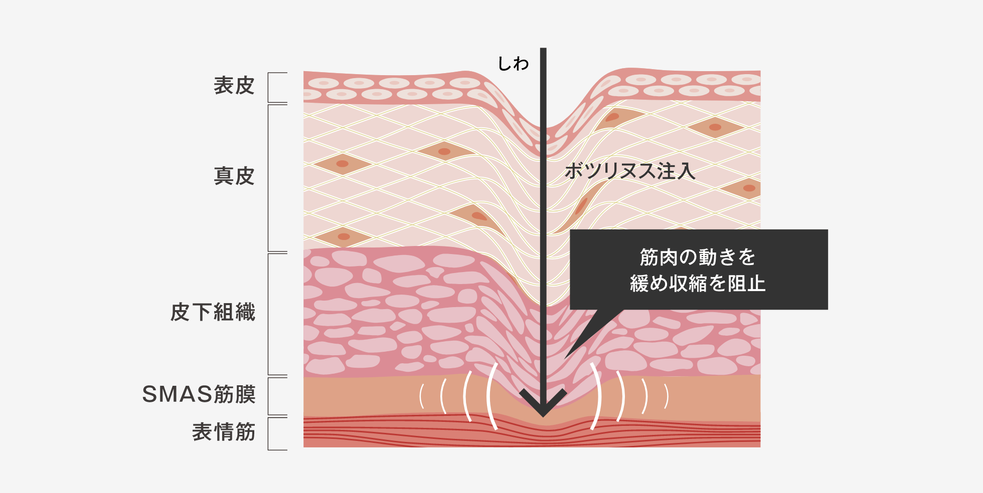ボトックス・ボツリヌス注入
