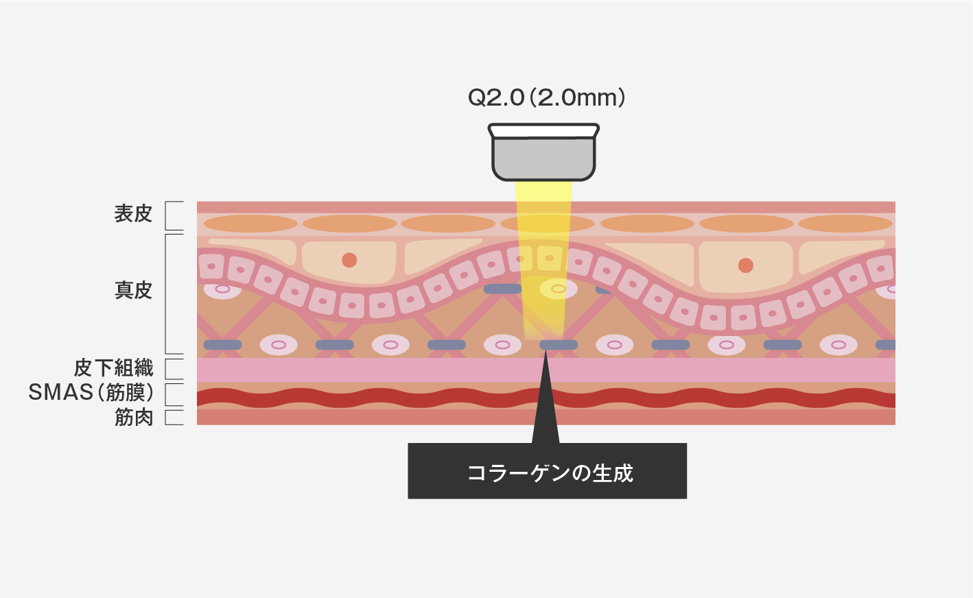 ハイフシャワー