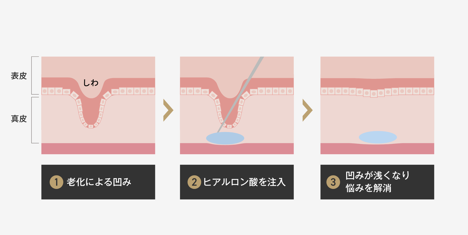 ヒアルロン酸注入