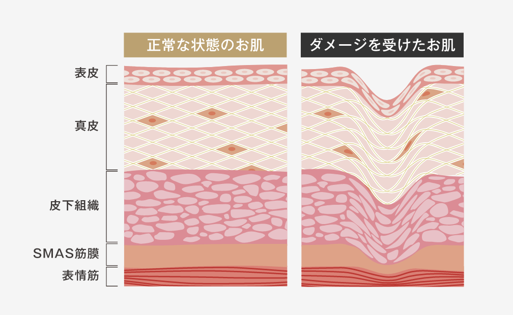 ニキビの原因