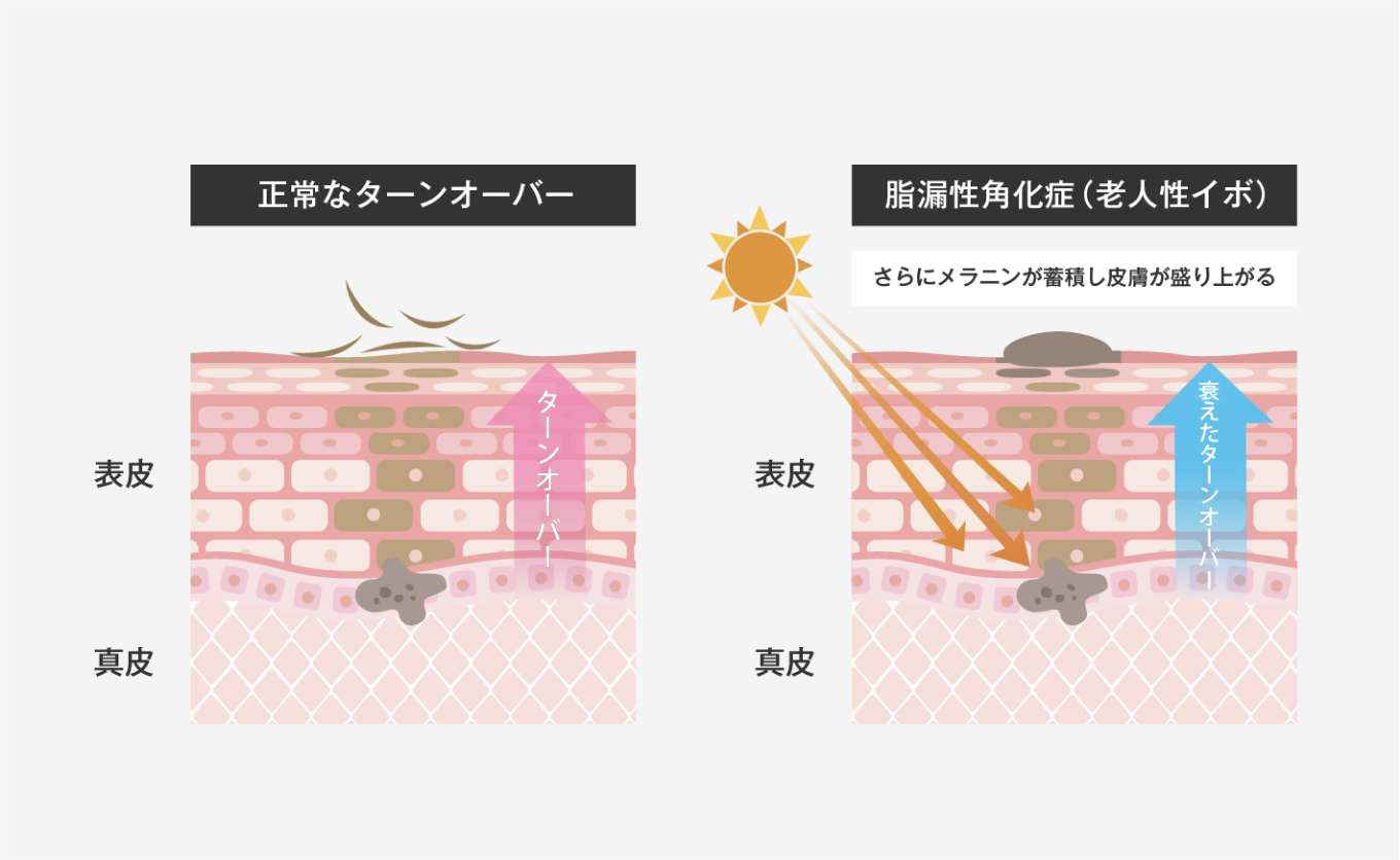 ほくろ・イボの原因