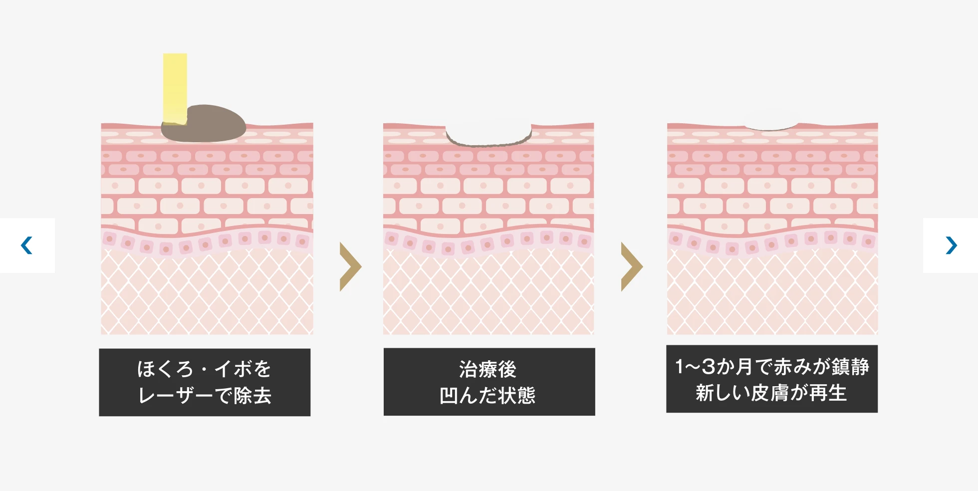 ほくろ・イボ治療の仕組み